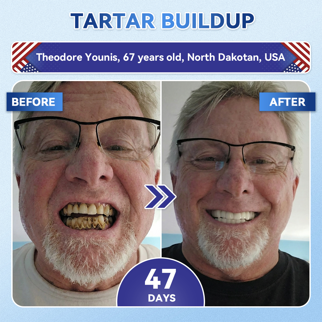 Glimmerly® 🦷 Tideglusib Fast‑Dissolving Tooth & Gum Repair Oral Strips 💥🎉 (Supports tooth repair and helps relieve gum discomfort and other common oral concerns)