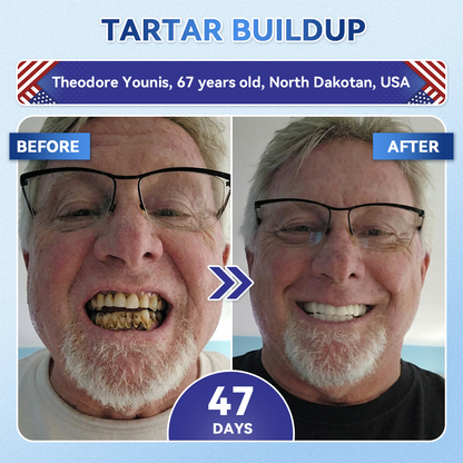 Glimmerly® 🦷 Tideglusib Fast‑Dissolving Tooth & Gum Repair Oral Strips 💥🎉 (Supports tooth repair and helps relieve gum discomfort and other common oral concerns)