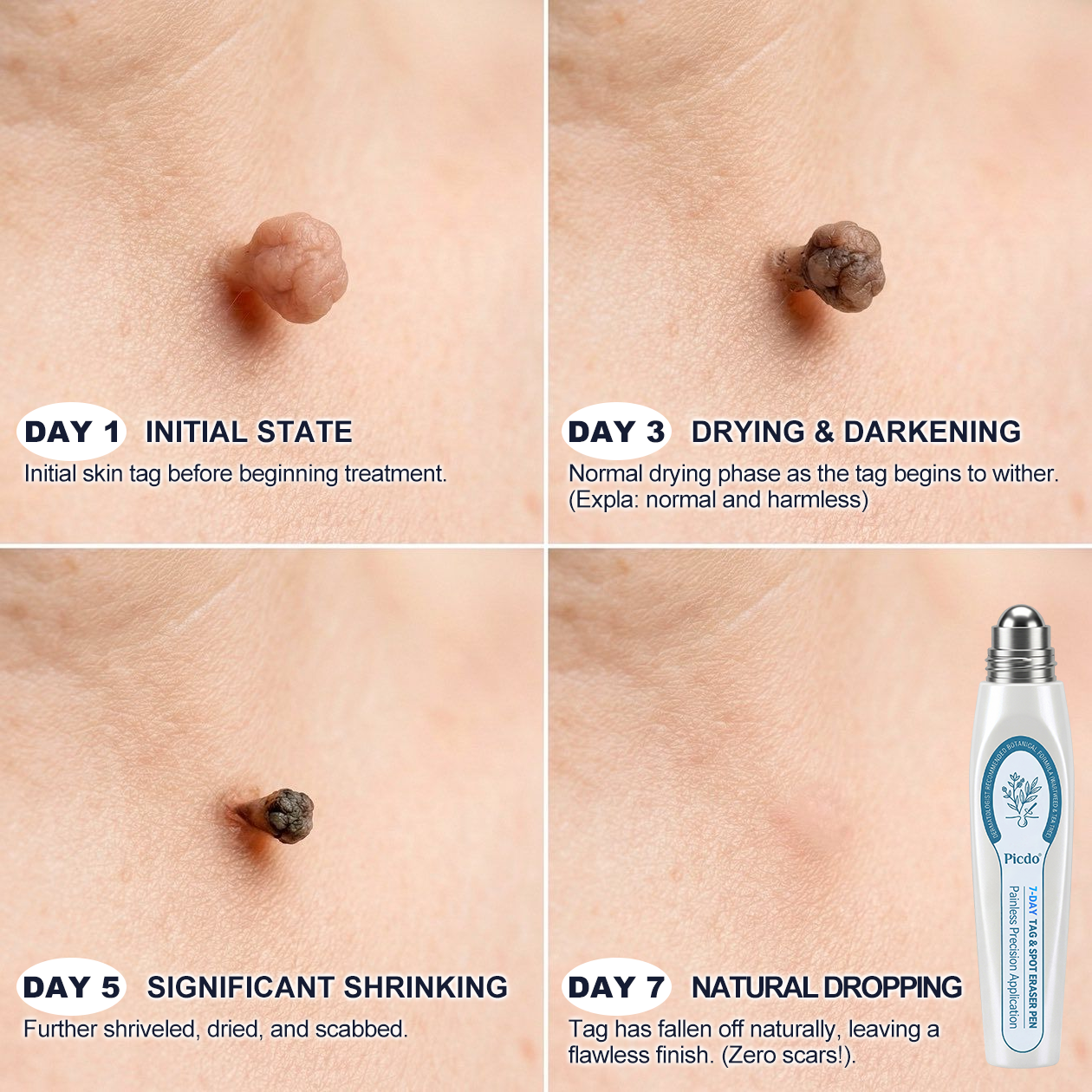 𝐏i𝐜𝐝o®🍀7-𝐷𝑎𝑦 𝗧𝐚𝐠 & 𝗦𝗽𝐨𝐭 𝐄𝐫𝒂𝒔𝒆𝒓(Zero Pain, Zero 𝐒𝐜𝐚𝒓𝒔 Rollerball)🥇