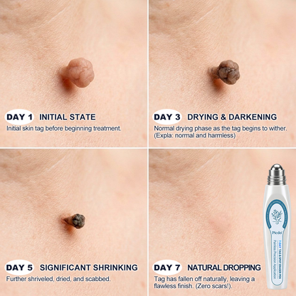 𝐏i𝐜𝐝o®🍀7-𝐷𝑎𝑦 𝗧𝐚𝐠 & 𝗦𝗽𝐨𝐭 𝐄𝐫𝒂𝒔𝒆𝒓(Zero Pain, Zero 𝐒𝐜𝐚𝒓𝒔 Rollerball)🥇